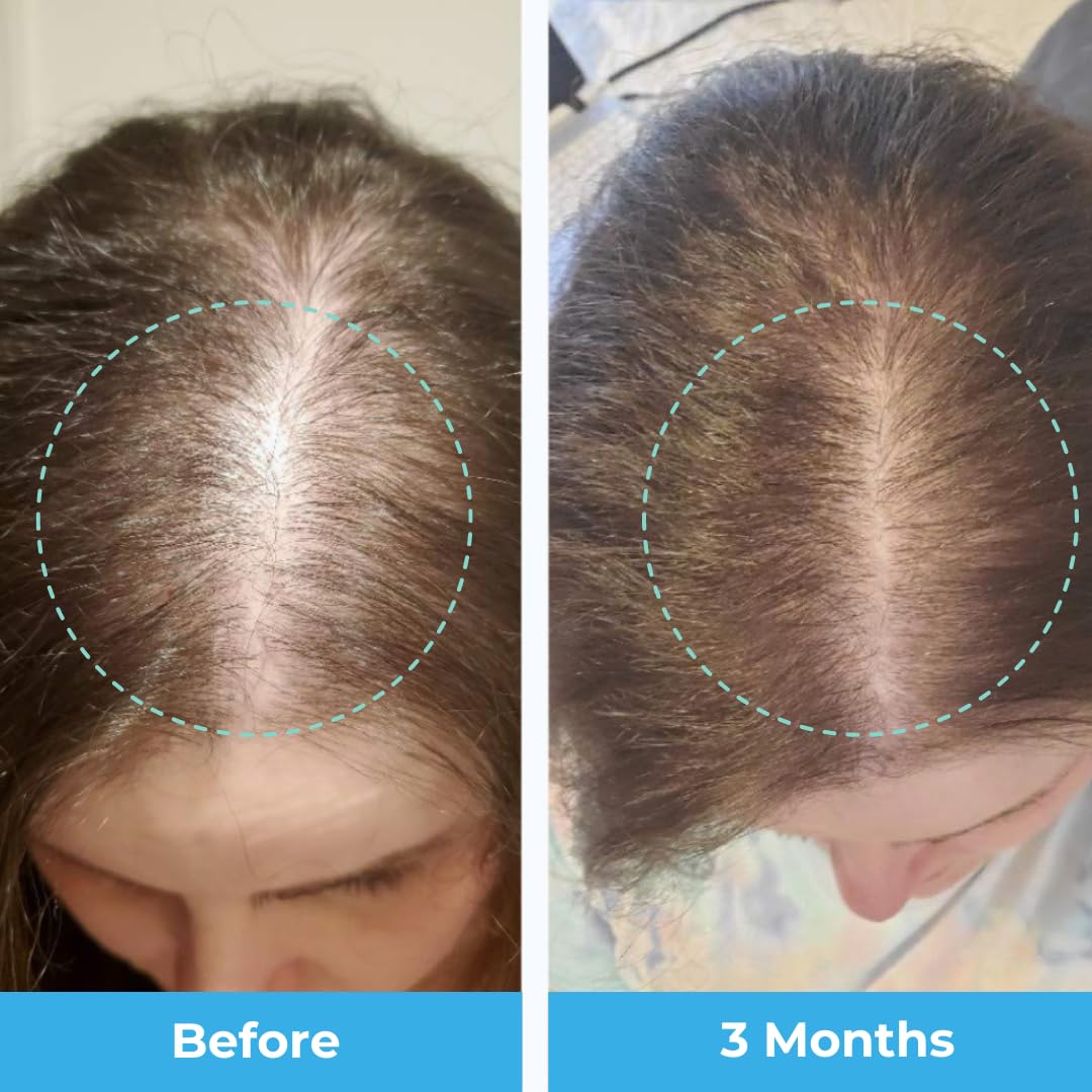 Baby Blues Postpartum Hair Loss Vitamins - Passion Fruit Gummies with Biotin, Collagen, & Folate - OmniHealth US