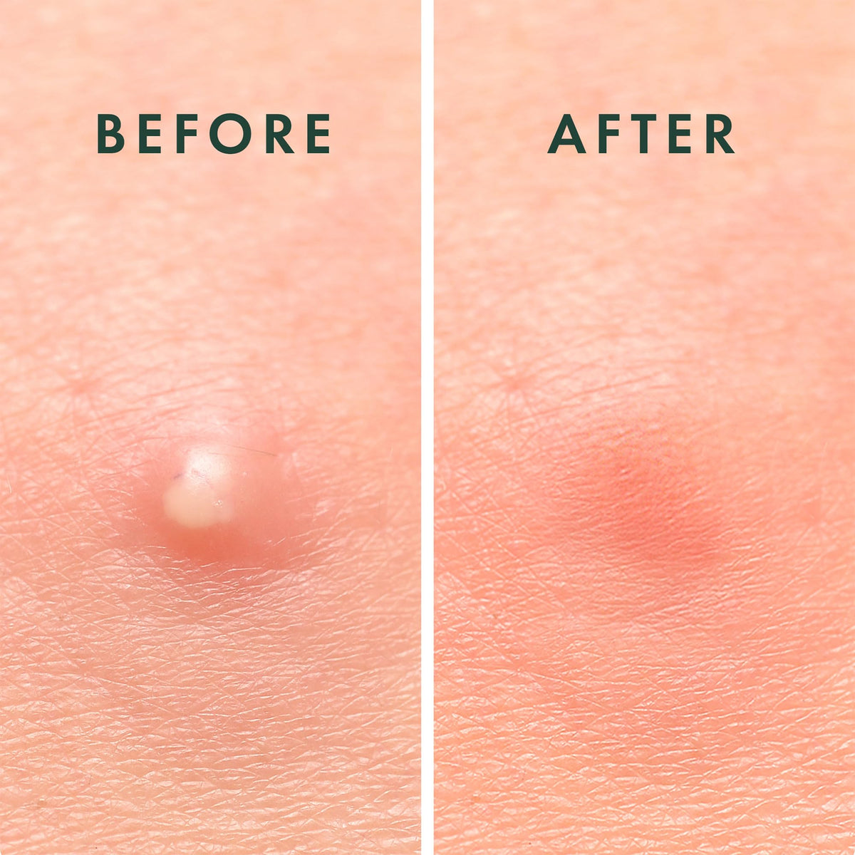 Rael Pimple Patches, Miracle Invisible Spot Cover - Hydrocolloid Acne Pimple Patch - Maple Wellness Supplements
